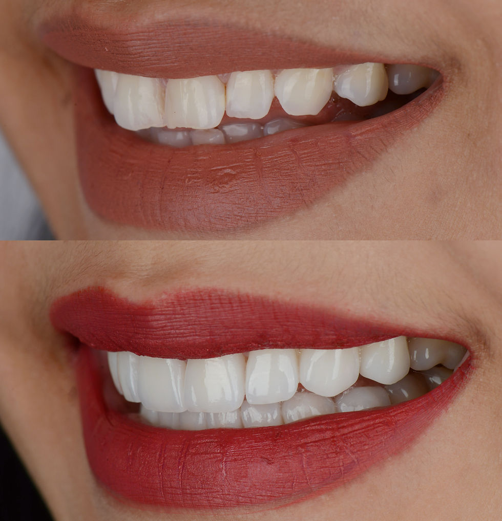 Porcelain Veneers New York Dr. Tristan Lue, DDS